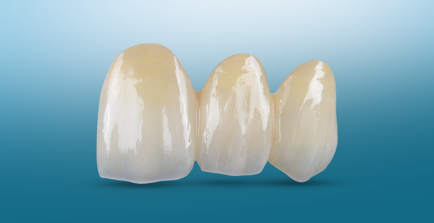 BruxZir Esthetic Solid Zirconia - New West Dental Ceramics