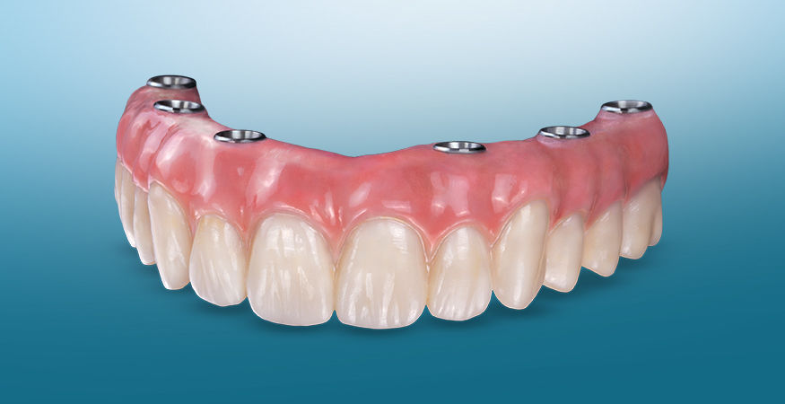 BruxZir Full-Arch Implant Prosthesis - New West Dental Ceramics