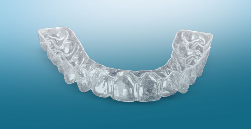 Clear Lock Retainers-for-Life – New West Dental Ceramics Clear Lock Retainers-for-Life - New West Dental Ceramics