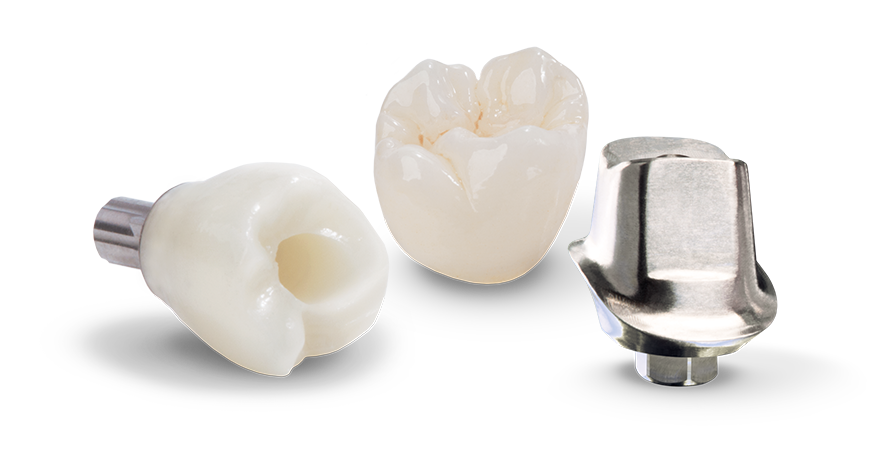 Restorations Over Implants - New West Dental Ceramics