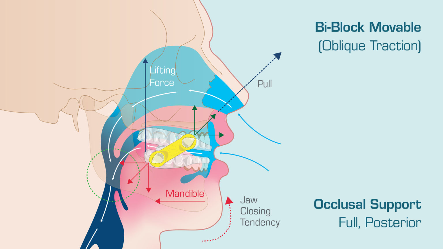 The EMA® Appliance: A Tried-and-True Snoring Solution| New West