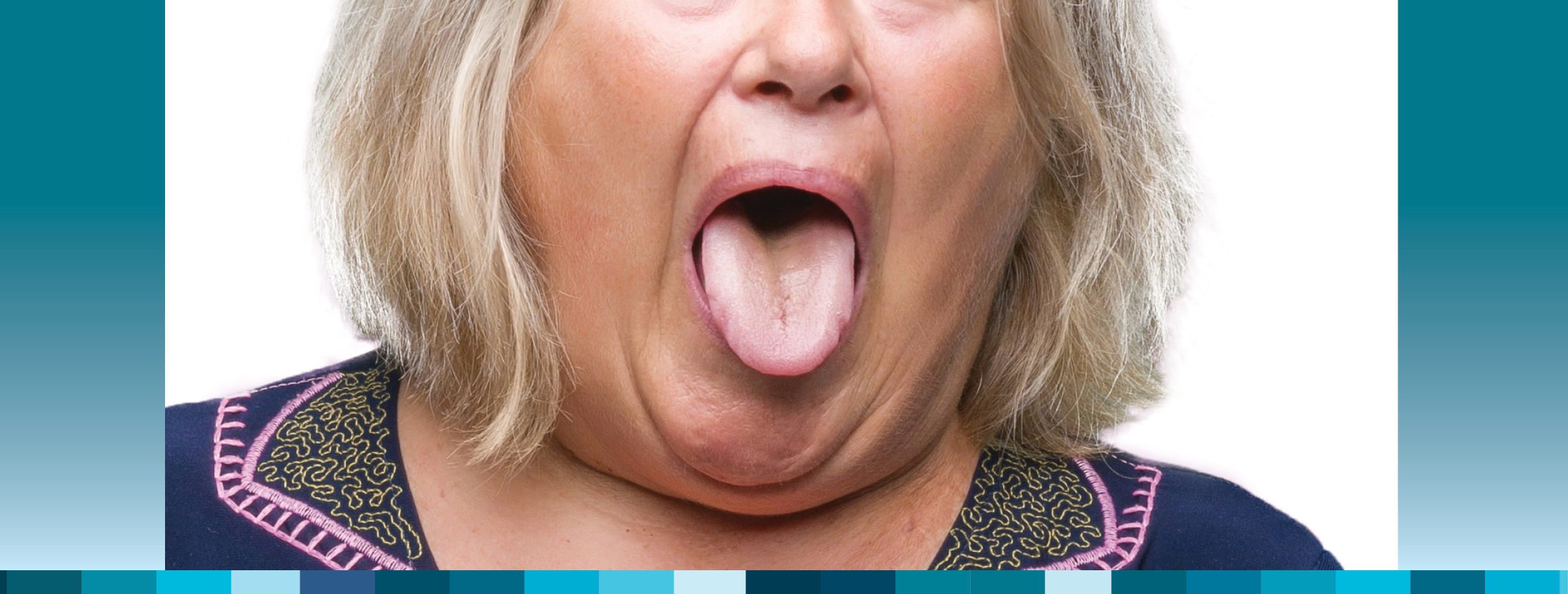 Patient with a 'big fat tongue' (BFT)