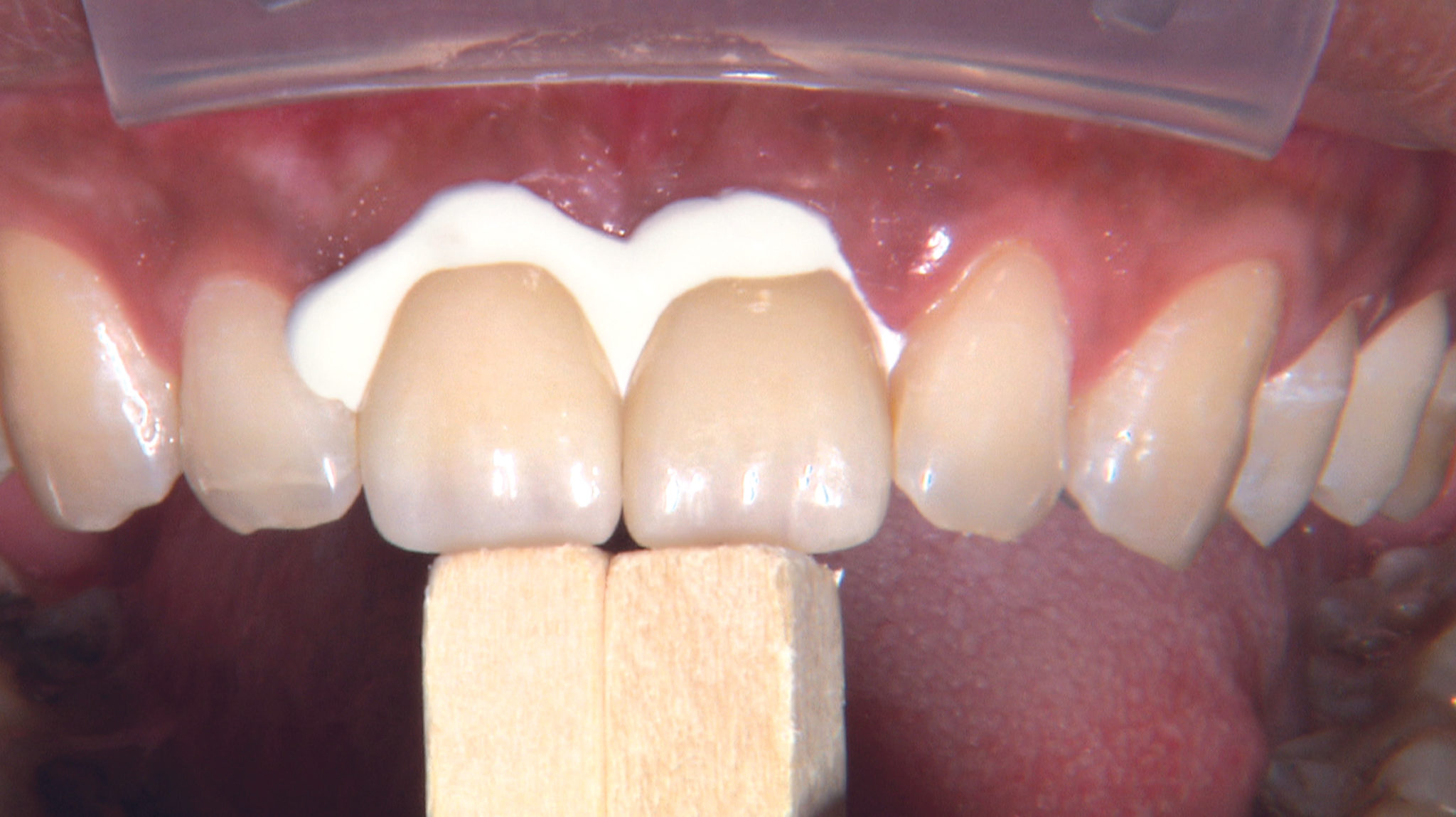 How to Prep and Cement BruxZir® Zirconia Crowns New West