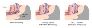 Dental Sleep Device for the Treatment of Sleep Apnea (OSA) | New West