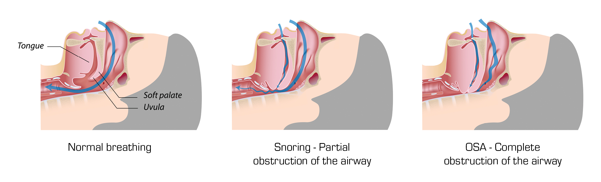 Diagram of snoring patterns: normal, snoring, and OSA