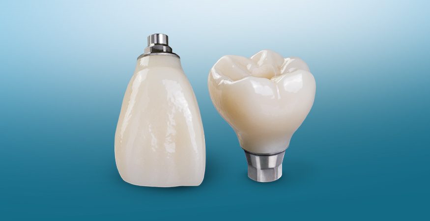 BruxZir Screw-Retained Implant Crowns - New West Dental Ceramics