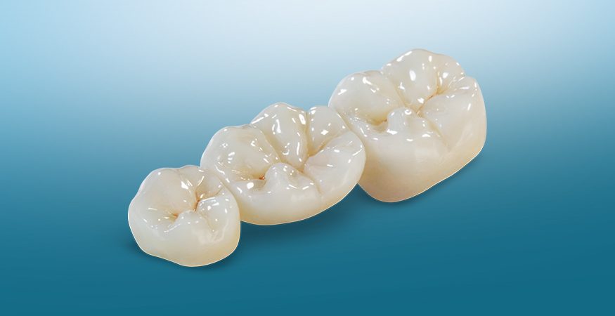 BruxZir Solid Zirconia - New West Dental Ceramics