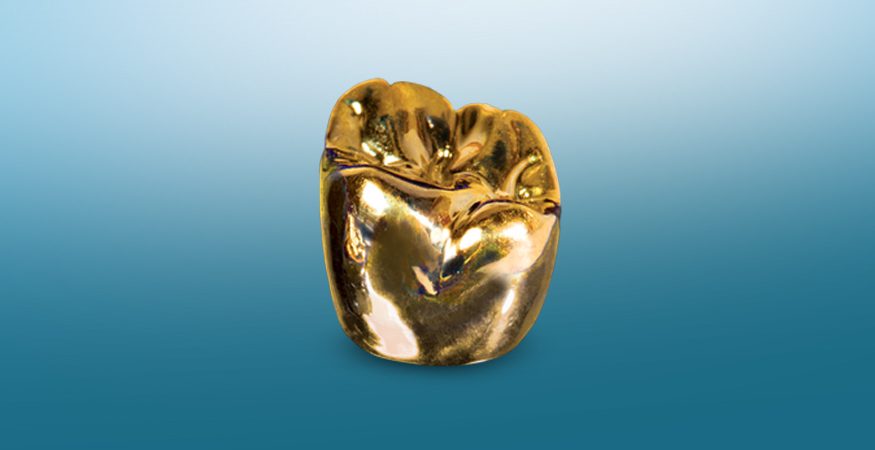 Full Cast Restorations - New West Dental Ceramics