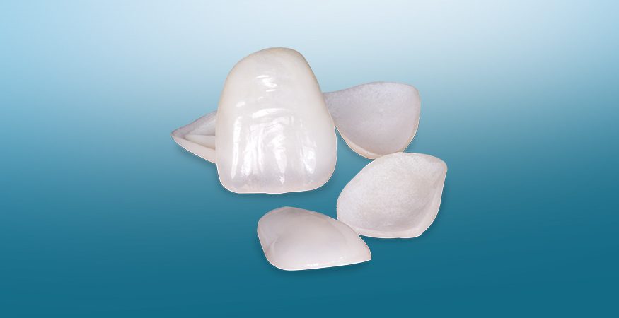 IPS E.max Veneers - New West Dental Ceramics