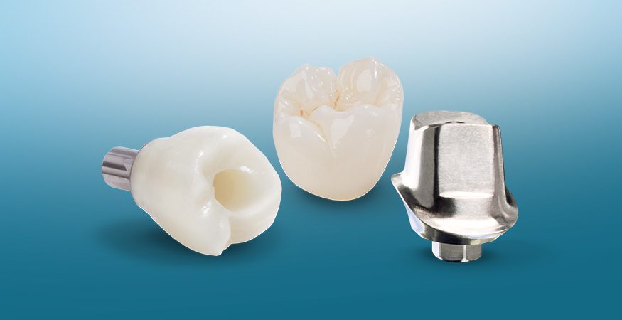 Restorations Over-Implants - New West Dental Ceramics