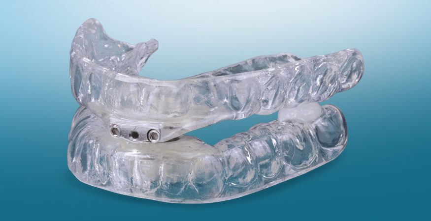 Sleep Appliances | New West Dental Lab
